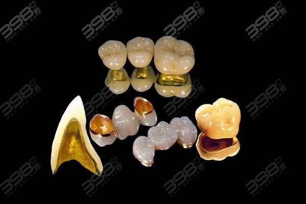 贵金属烤瓷牙的价格(贵金属烤瓷牙的价格是多少)