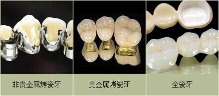 口腔贵金属(口腔贵金属肩台)